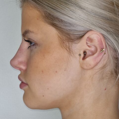 Non-Surgical Rhinoplasty Middlesbrough