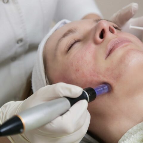 Secret Pro Microneedling Treatment Middlesbrough