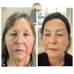 Full face rejuvenation package, 12ml